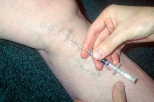 skleroterapie pro křečové žíly