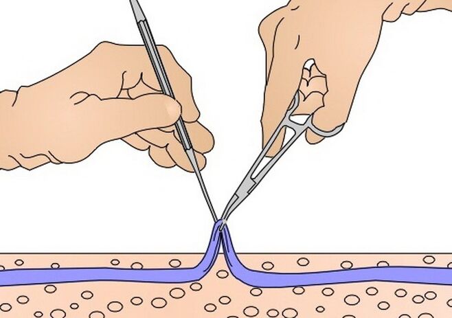 stripování žil na křečové žíly