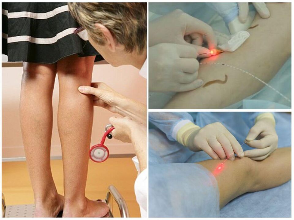 Průběh laserové koagulační procedury pro křečové žíly na nohou
